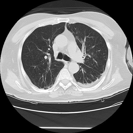 Cavitating pulmonary metastases (Radiopaedia 89545-106544 Axial lung window 23).jpg