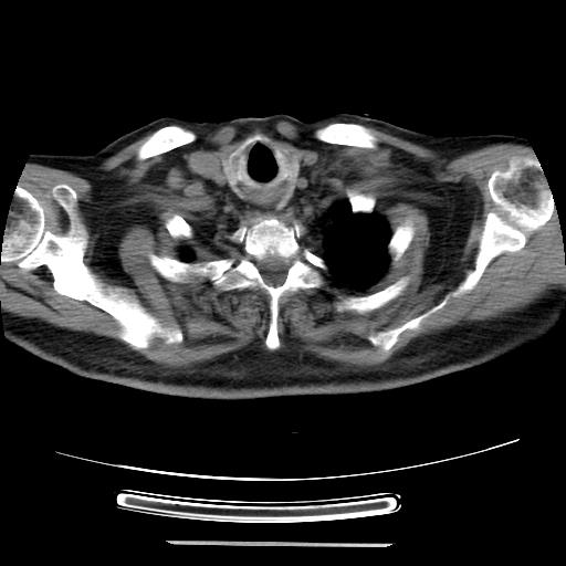Cavitating pulmonary metastases (Radiopaedia 89545-106544 Axial non-contrast 3).jpg