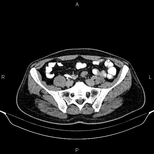 Cecal adenocarcinoma (Radiopaedia 85324-100916 Axial C+ delayed 73).jpg