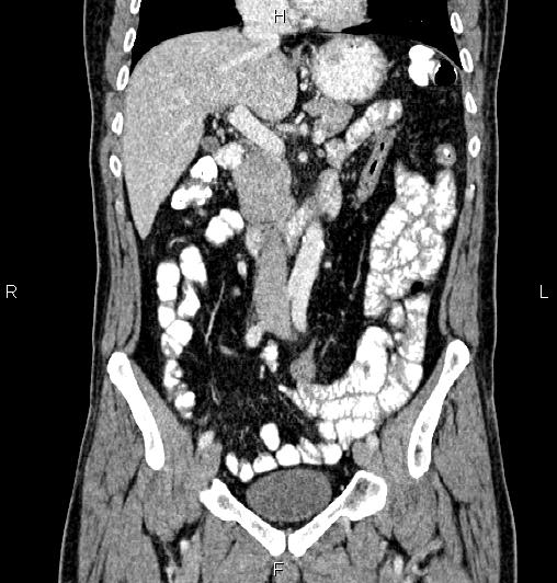 Cecal adenocarcinoma (Radiopaedia 85324-100916 D 27).jpg