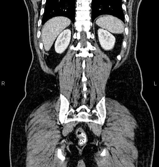 Cecal adenocarcinoma (Radiopaedia 85324-100916 D 56).jpg