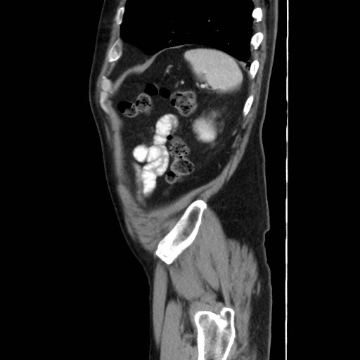 Cecal mass causing appendicitis (Radiopaedia 59207-66531 C 55).jpg