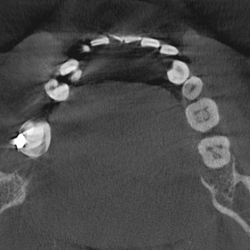 Cemento-osseous dysplasia (Radiopaedia 48251-53126 Axial non-contrast 62).jpg
