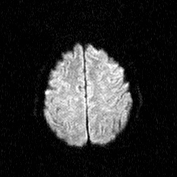 File:Central-variant posterior reversible encephalopathy syndrome (PRES) (Radiopaedia 43880-47358 Axial DWI 18).jpg