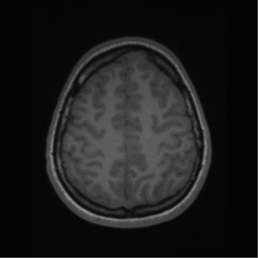 File:Central neurocytoma (Radiopaedia 37664-39557 Axial T1 59).png