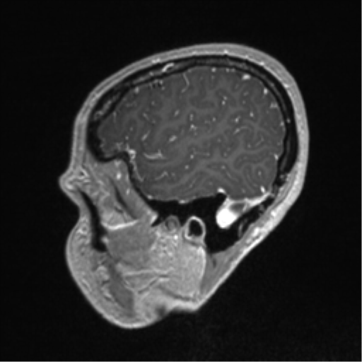 Central neurocytoma (Radiopaedia 37664-39557 Sagittal T1 C+ 80).png