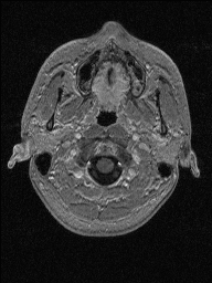 Central neurocytoma (Radiopaedia 56690-63469 Axial T1 C+ 15).jpg