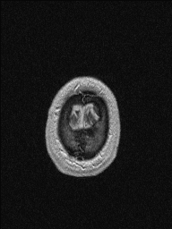 Central neurocytoma (Radiopaedia 56690-63469 Axial T1 C+ 155).jpg