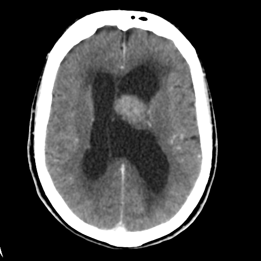 Central neurocytoma (Radiopaedia 65317-74346 Axial C+ delayed 29).png