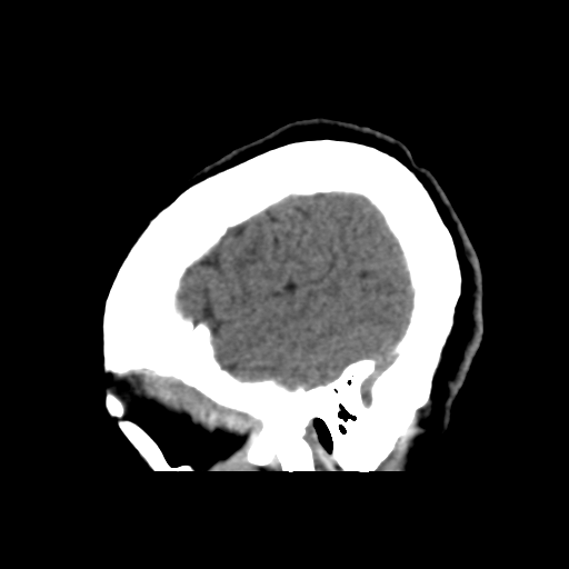 File:Central neurocytoma (Radiopaedia 65317-74346 C 10).png
