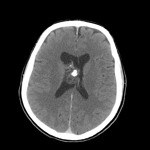 Central neurocytoma (Radiopaedia 68725-78432 Axial C+ 51).jpg