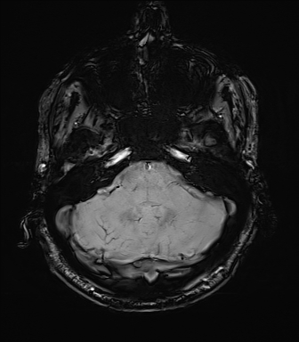 File:Central neurocytoma (Radiopaedia 71068-81303 Axial SWI 10).jpg