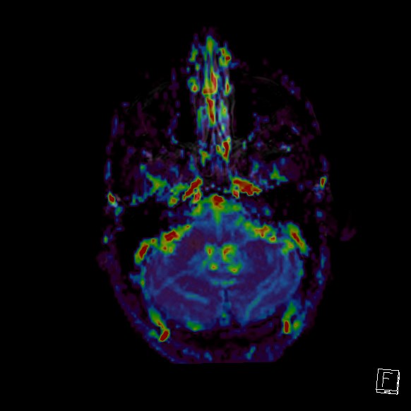 Central neurocytoma (Radiopaedia 84497-99872 Axial Perfusion 247).jpg