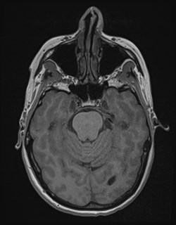 Central neurocytoma (Radiopaedia 84497-99872 Axial T1 68).jpg