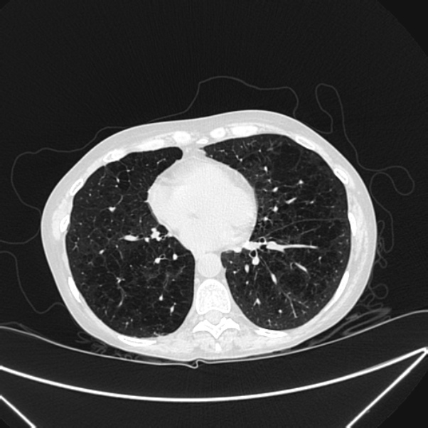 Centrilobular pulmonary emphysema (Radiopaedia 24495-24789 Axial lung window 61).jpg