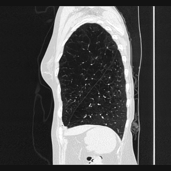 Centrilobular pulmonary emphysema (Radiopaedia 24495-24789 Sagittal lung window 72).jpg