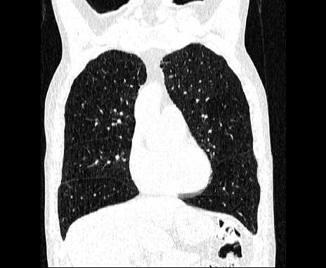 Centrilobular pulmonary emphysema (Radiopaedia 62468-70718 Coronal lung window 24).jpg