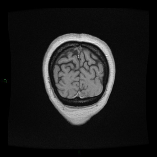 File:Cerebellar abscess (Radiopaedia 78135-90678 Coronal T1 C+ 158).jpg