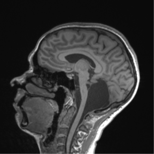 Cerebellar agenesis with hypoplastic pons (pontocerebellar hypoplasia) (Radiopaedia 57224-64138 Sagittal T1 34).png