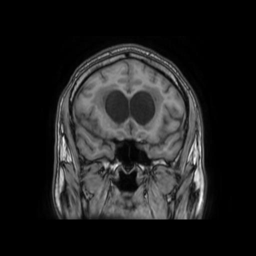 File:Cerebellar hemangioblastoma (Radiopaedia 88055-104622 Coronal T1 13).jpg