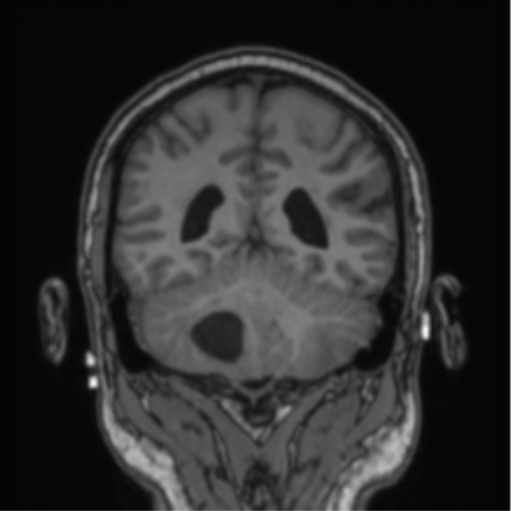 Cerebellar hemangioblastomas and pituitary adenoma (Radiopaedia 85490-101176 Coronal T1 33).png