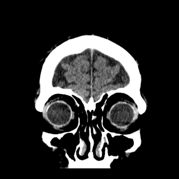 Cerebellar hemorrhage (Radiopaedia 27193-27359 Coronal non-contrast 10).jpg
