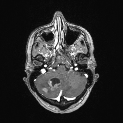 File:Cerebellar metastases (Radiopaedia 24038-24249 Axial T1 C+ 44).jpg