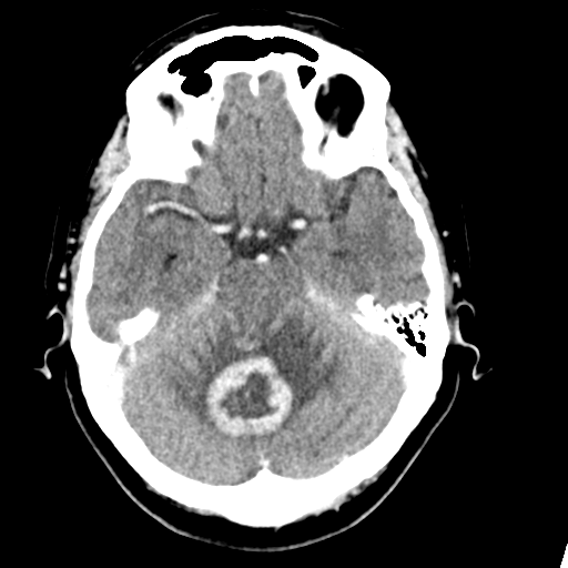 File:Cerebellar metastasis (Radiopaedia 54578-60812 Axial C+ 16).png