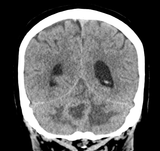 File:Cerebellar metastasis (Radiopaedia 54578-60812 Coronal non-contrast 43).png