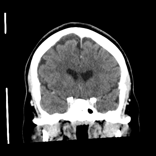 Cerebellar metastasis (cystic appearance) (Radiopaedia 41395-44258 D 25).png
