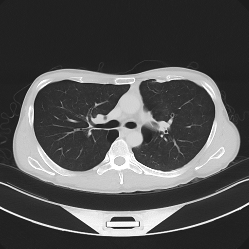 Cerebellar metastasis - adenocarcinoma lung (Radiopaedia 63184-71717 Axial lung window 28).png