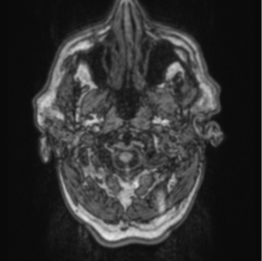 Cerebellar metastasis from lung adenocarcinoma (Radiopaedia 86690-102829 Axial T1 6).png