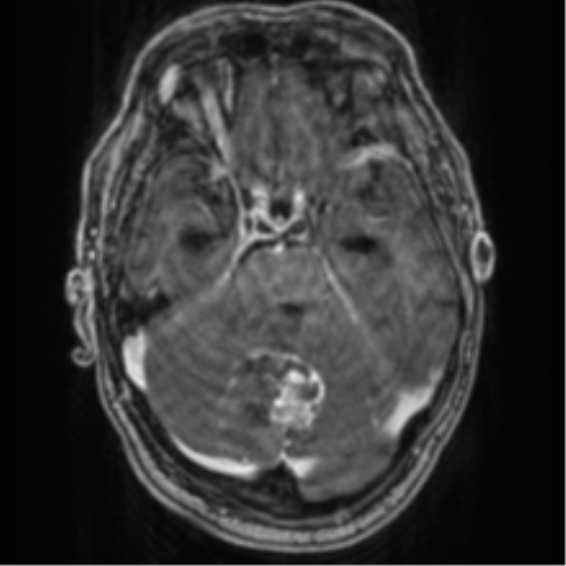 Cerebellar metastasis from lung adenocarcinoma (Radiopaedia 86690-102829 Axial T1 C+ 28).png
