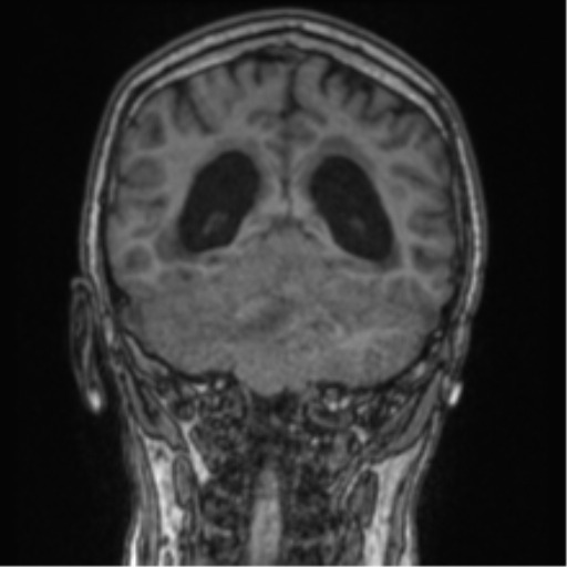 Cerebellar metastasis from lung adenocarcinoma (Radiopaedia 86690-102829 Coronal T1 37).png