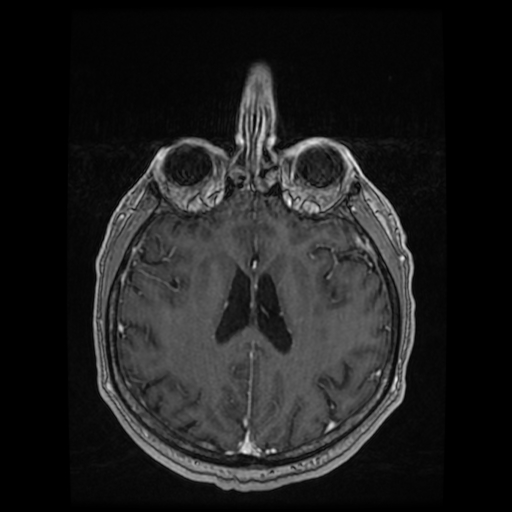 Cerebellar metastasis of pulmonary adenocarcinoma, cavernous venous malformation, and developmental venous anomaly (Radiopaedia 85827-101661 Axial T1 C+ 60).jpg