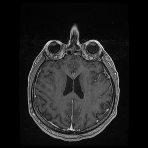File:Cerebellar metastasis of pulmonary adenocarcinoma, cavernous venous malformation, and developmental venous anomaly (Radiopaedia 85827-101661 Axial T1 C+ 62).jpg