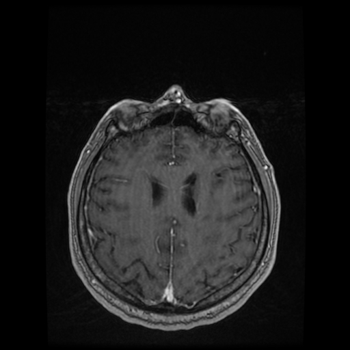 Cerebellar metastasis of pulmonary adenocarcinoma, cavernous venous malformation, and developmental venous anomaly (Radiopaedia 85827-101661 Axial T1 C+ 66).jpg