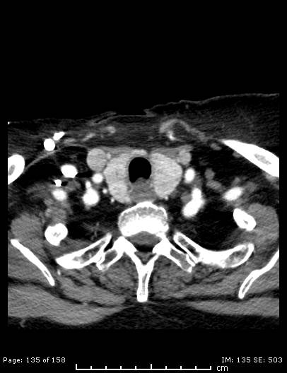 File:Cerebellar strokes due to intracranial giant cell arteritis (Radiopaedia 68799-78510 CT angiogram 135).jpg
