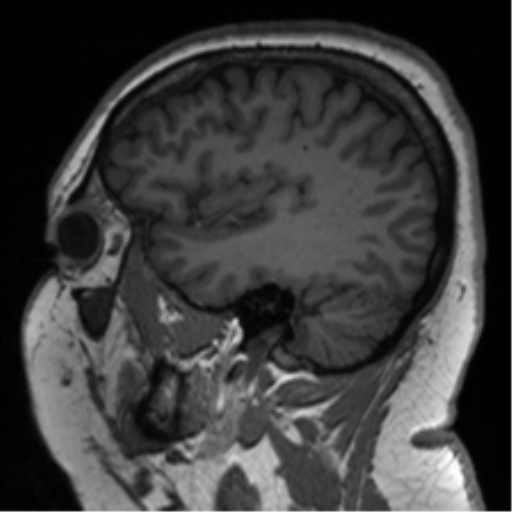 Cerebellopontine angle meningioma (Radiopaedia 48434-53348 Sagittal T1 26).png