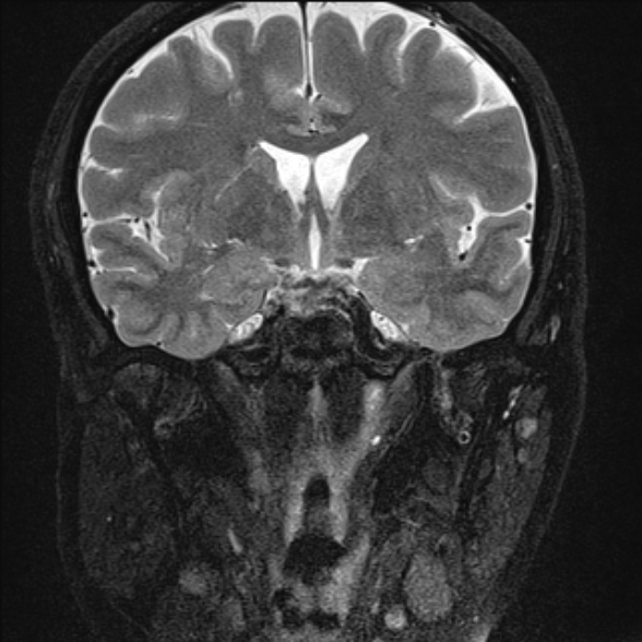 File:Cerebellopontine angle meningioma (Radiopaedia 53561-59591 Coronal T2 4).jpg