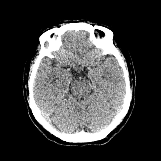 Cerebellopontine angle meningioma (Radiopaedia 53561-59592 Axial non-contrast 24).jpg