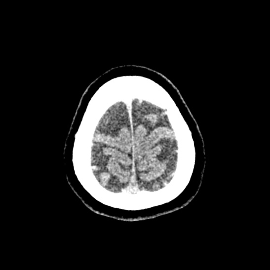 Cerebellopontine angle meningioma (Radiopaedia 53561-59592 Axial non-contrast 63).jpg