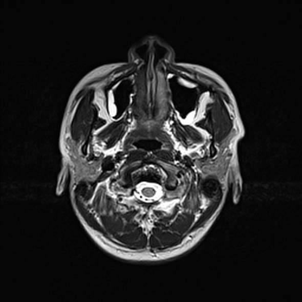 Cerebral abscess (Radiopaedia 24212-24478 Axial T2 8).jpg