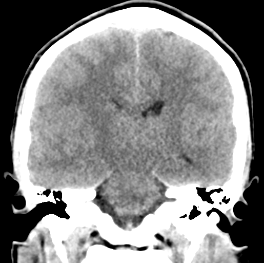 Cerebral abscess (Radiopaedia 60342-68008 Coronal non-contrast 36).png