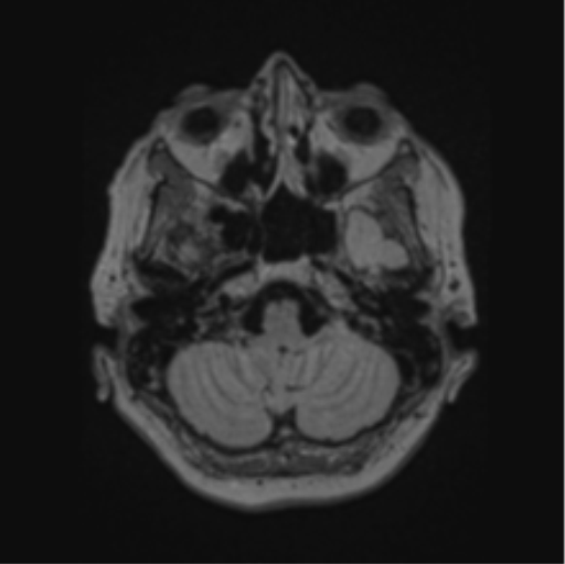 Cerebral abscess from pulmonary arteriovenous malformation (Radiopaedia 86275-102291 J 18).png