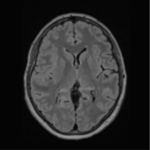 Cerebral abscess from pulmonary arteriovenous malformation (Radiopaedia 86275-102291 J 40).png