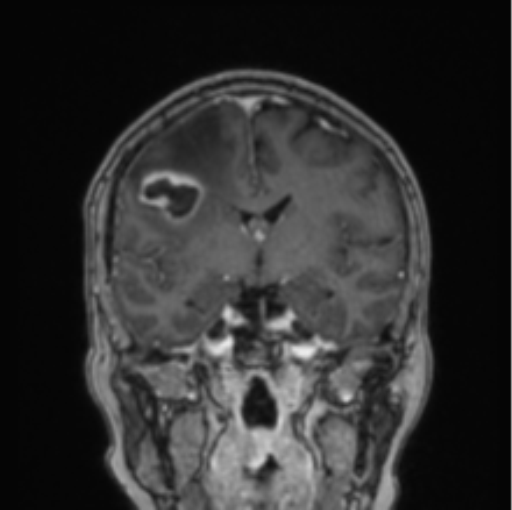 Cerebral abscess from pulmonary arteriovenous malformation (Radiopaedia 86275-102291 L 50).png