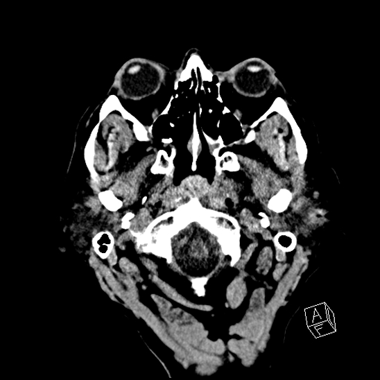 Cerebral abscess with ventriculitis (Radiopaedia 78965-91876 Axial non-contrast 6).jpg