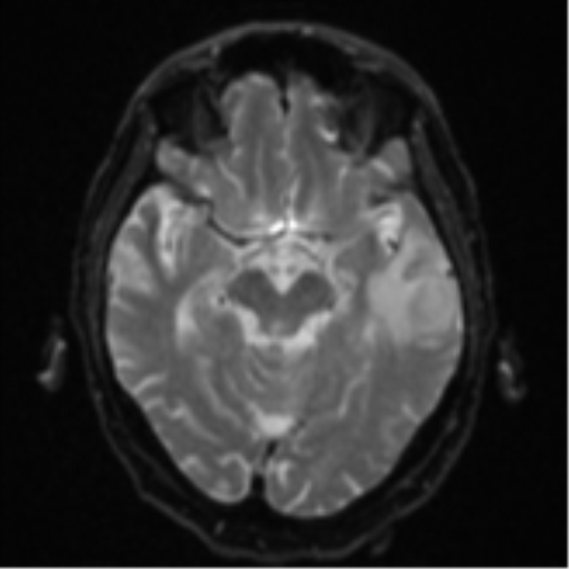 Cerebral abscesses- medically managed (Radiopaedia 45183-49179 Axial DWI 12).png