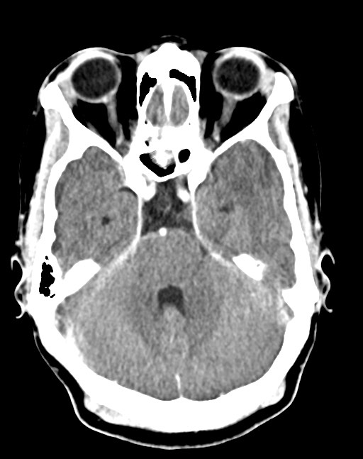 Cerebral abscesses (Radiopaedia 70458-80568 Axial Contrast 22).jpg